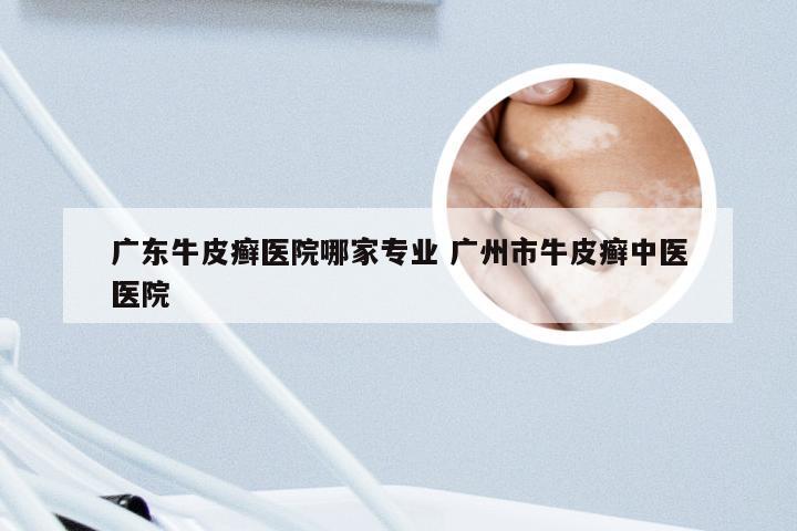 广东牛皮癣医院哪家专业 广州市牛皮癣中医医院
