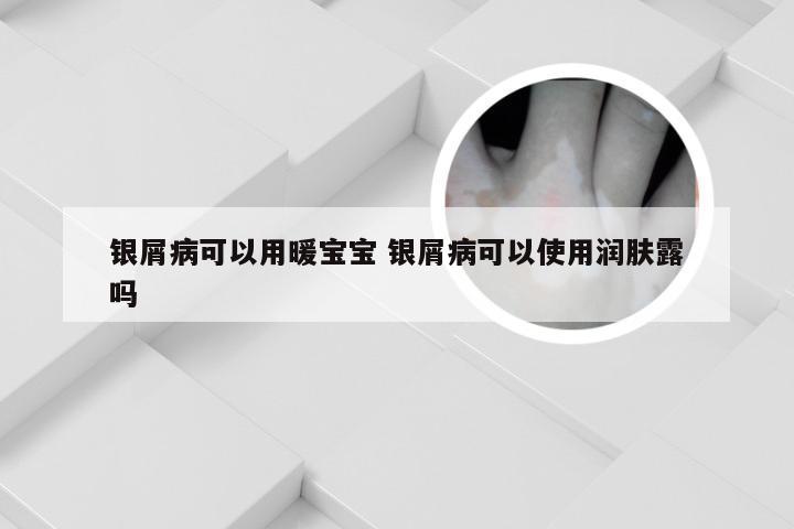 银屑病可以用暖宝宝 银屑病可以使用润肤露吗