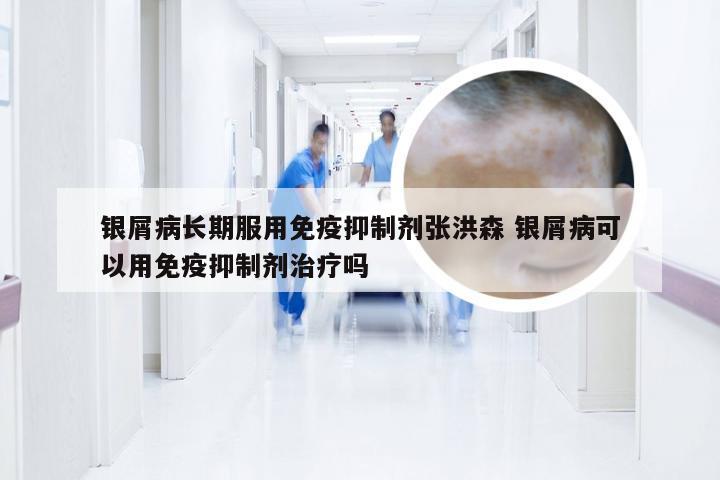 银屑病长期服用免疫抑制剂张洪森 银屑病可以用免疫抑制剂治疗吗