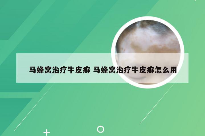 马蜂窝治疗牛皮癣 马蜂窝治疗牛皮癣怎么用