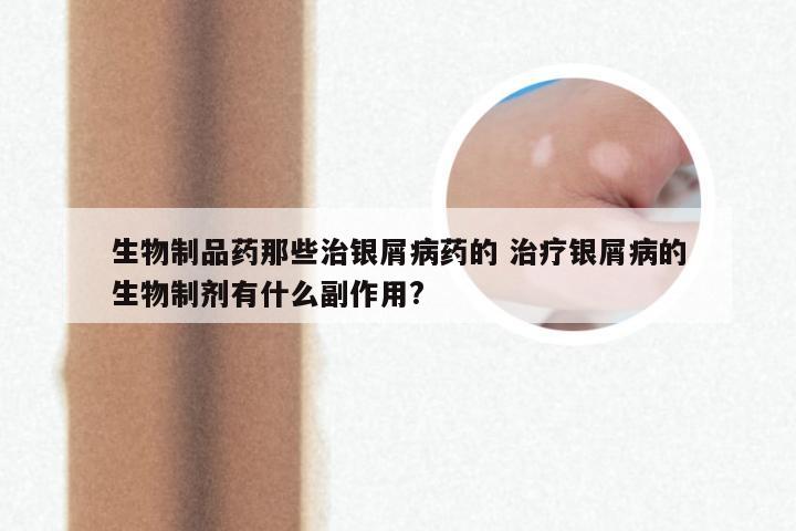生物制品药那些治银屑病药的 治疗银屑病的生物制剂有什么副作用?