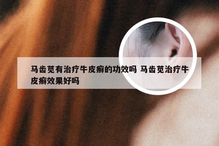 马齿苋有治疗牛皮癣的功效吗 马齿苋治疗牛皮癣效果好吗