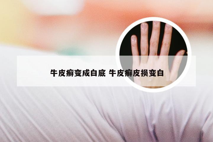 牛皮癣变成白底 牛皮癣皮损变白