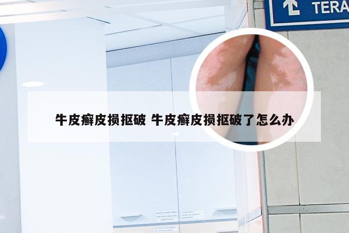牛皮癣皮损抠破 牛皮癣皮损抠破了怎么办
