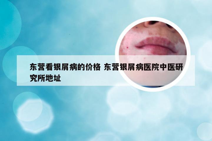 东营看银屑病的价格 东营银屑病医院中医研究所地址