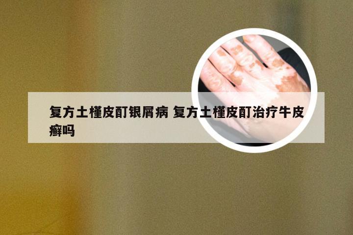 复方土槿皮酊银屑病 复方土槿皮酊治疗牛皮癣吗