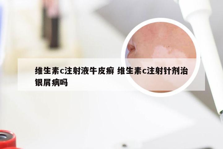 维生素c注射液牛皮癣 维生素c注射针剂治银屑病吗