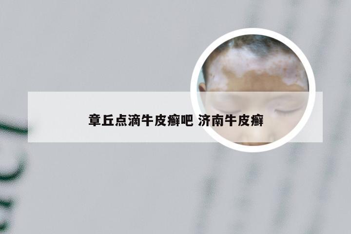 章丘点滴牛皮癣吧 济南牛皮癣