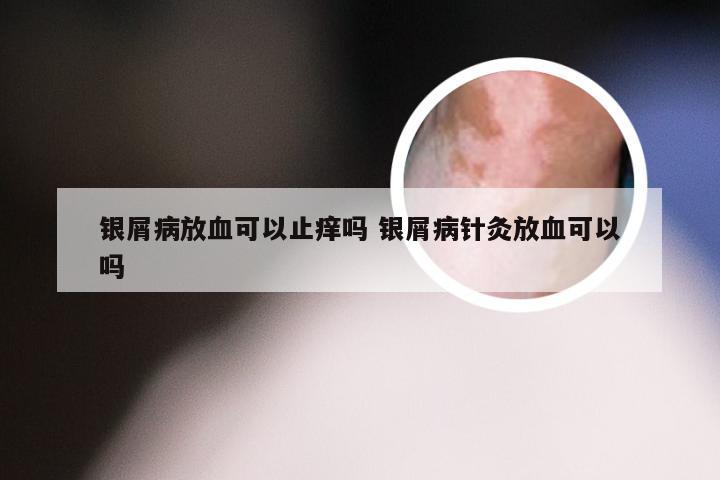 银屑病放血可以止痒吗 银屑病针灸放血可以吗