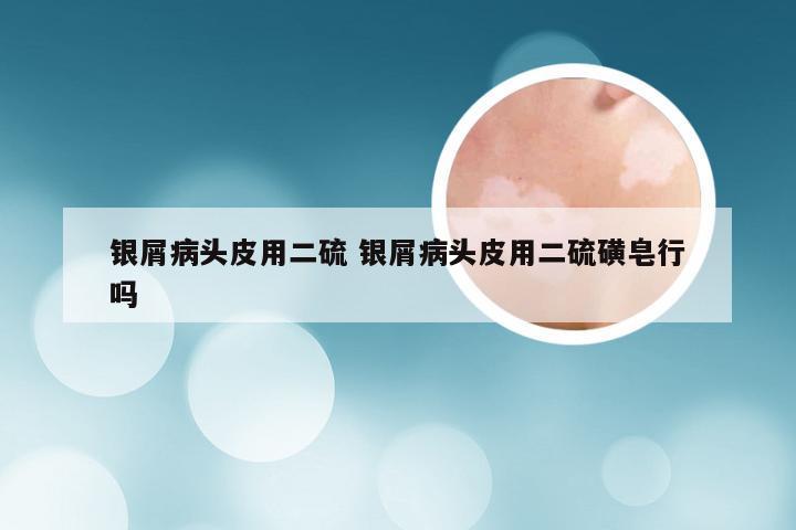 银屑病头皮用二硫 银屑病头皮用二硫磺皂行吗