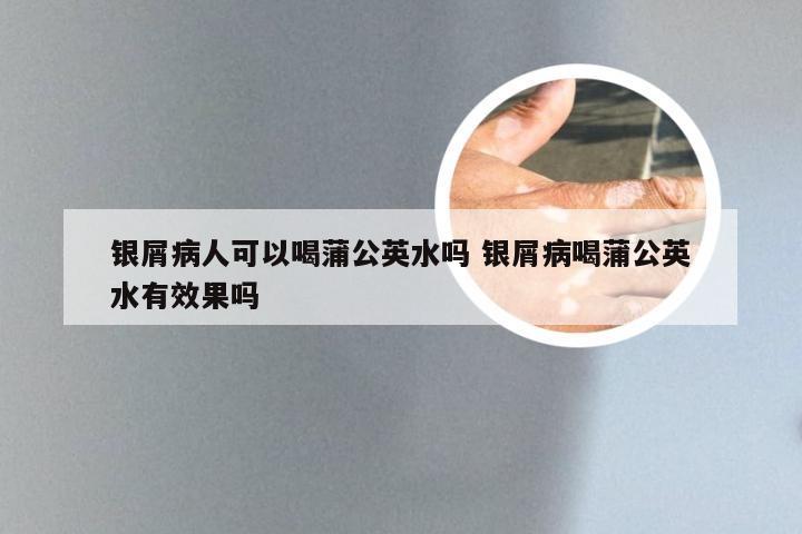 银屑病人可以喝蒲公英水吗 银屑病喝蒲公英水有效果吗