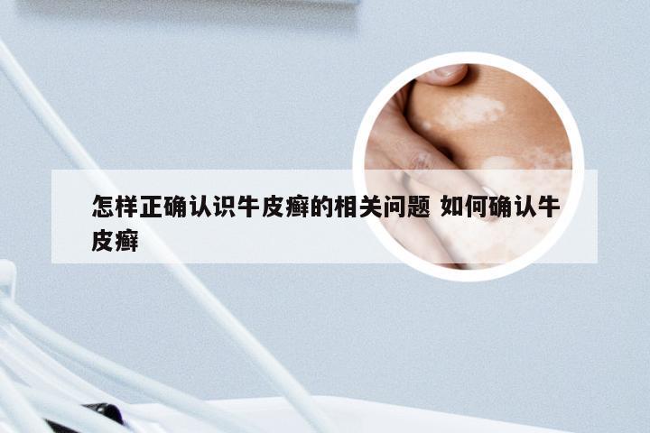 怎样正确认识牛皮癣的相关问题 如何确认牛皮癣