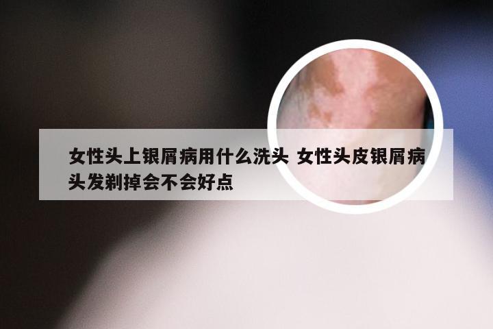 女性头上银屑病用什么洗头 女性头皮银屑病头发剃掉会不会好点