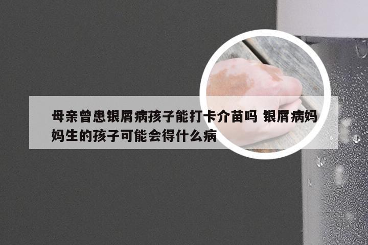 母亲曾患银屑病孩子能打卡介苗吗 银屑病妈妈生的孩子可能会得什么病