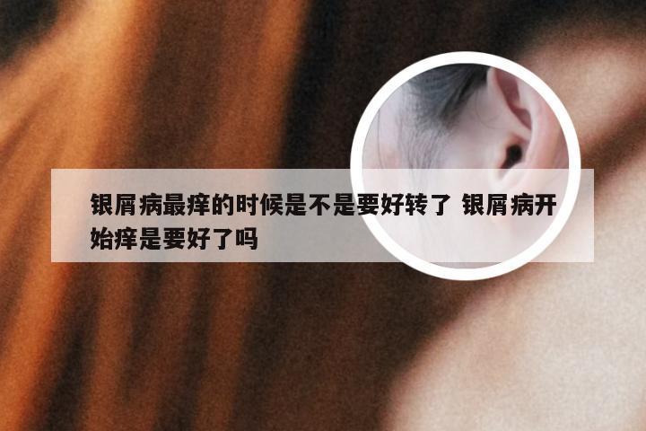 银屑病最痒的时候是不是要好转了 银屑病开始痒是要好了吗