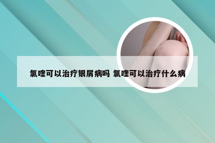 氯喹可以治疗银屑病吗 氯喹可以治疗什么病