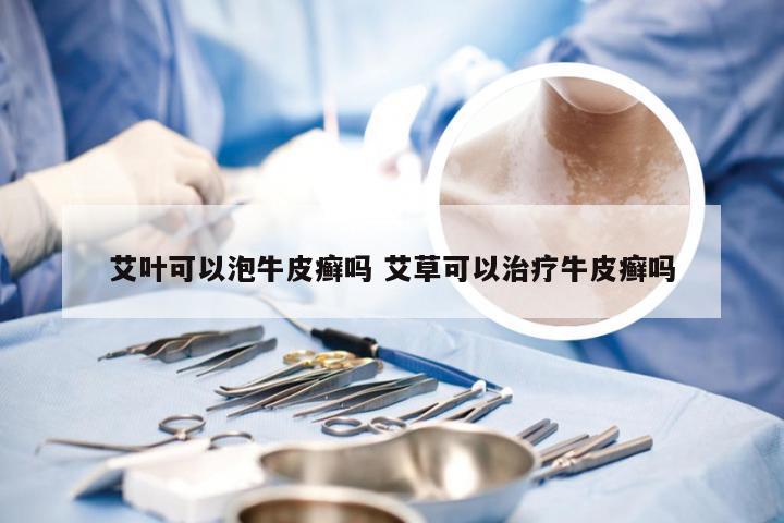艾叶可以泡牛皮癣吗 艾草可以治疗牛皮癣吗