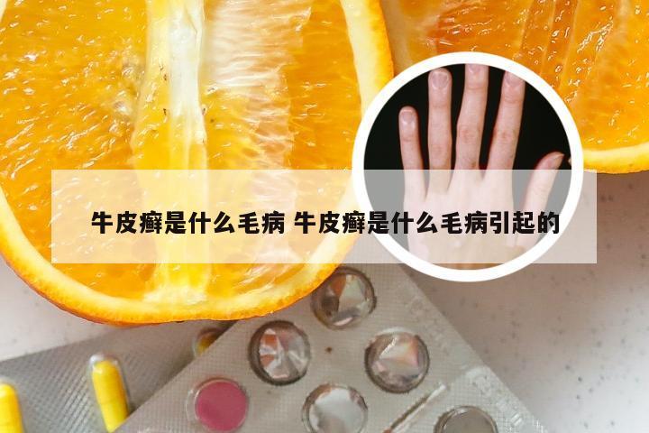 牛皮癣是什么毛病 牛皮癣是什么毛病引起的
