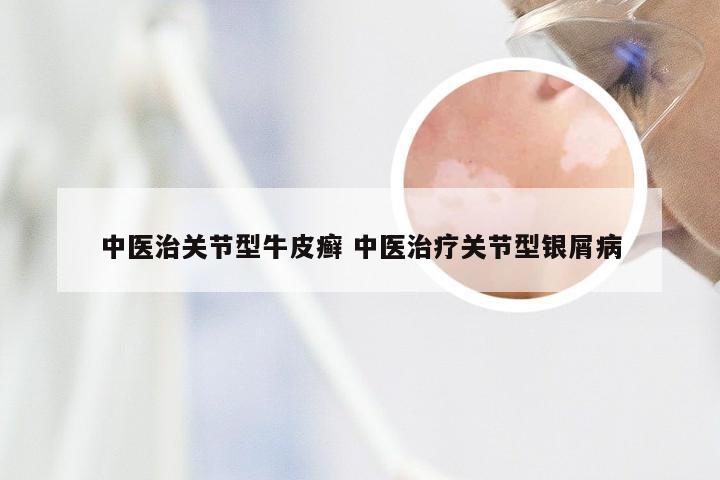 中医治关节型牛皮癣 中医治疗关节型银屑病