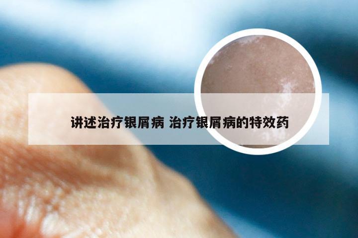 讲述治疗银屑病 治疗银屑病的特效药
