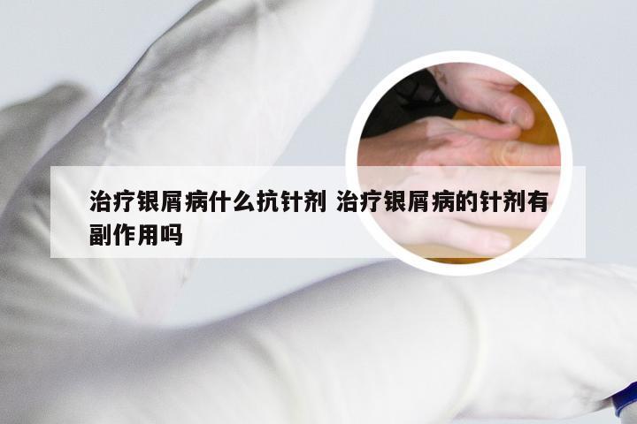 治疗银屑病什么抗针剂 治疗银屑病的针剂有副作用吗