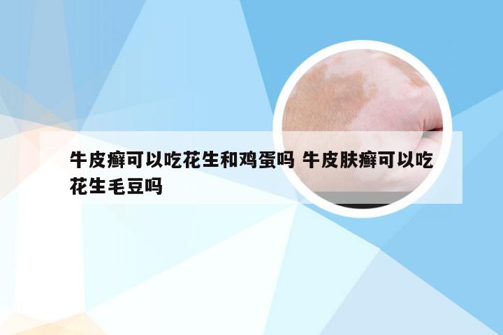 牛皮癣可以吃花生和鸡蛋吗 牛皮肤癣可以吃花生毛豆吗