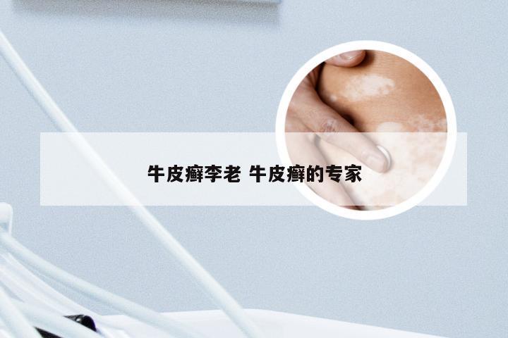 牛皮癣李老 牛皮癣的专家