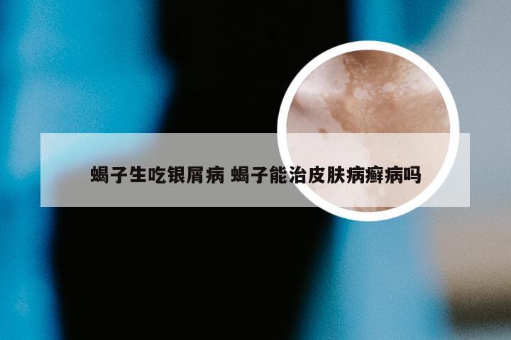 蝎子生吃银屑病 蝎子能治皮肤病癣病吗