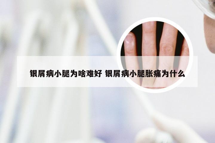 银屑病小腿为啥难好 银屑病小腿胀痛为什么