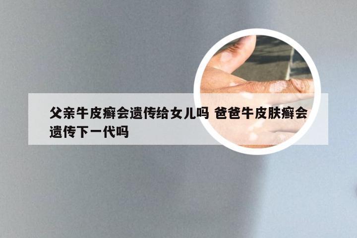 父亲牛皮癣会遗传给女儿吗 爸爸牛皮肤癣会遗传下一代吗