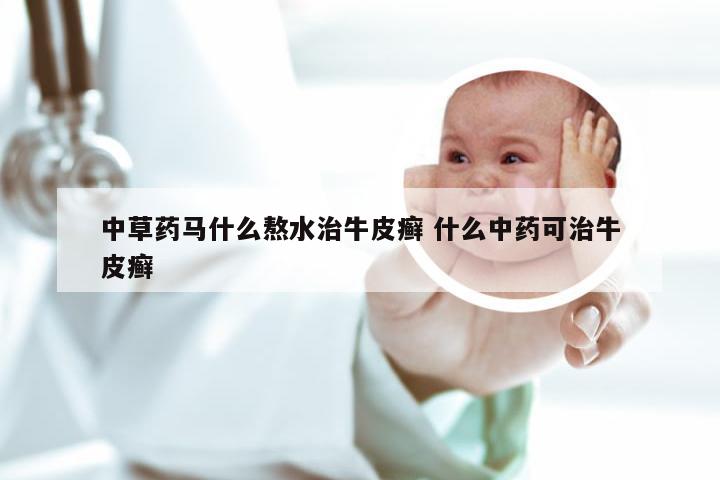中草药马什么熬水治牛皮癣 什么中药可治牛皮癣