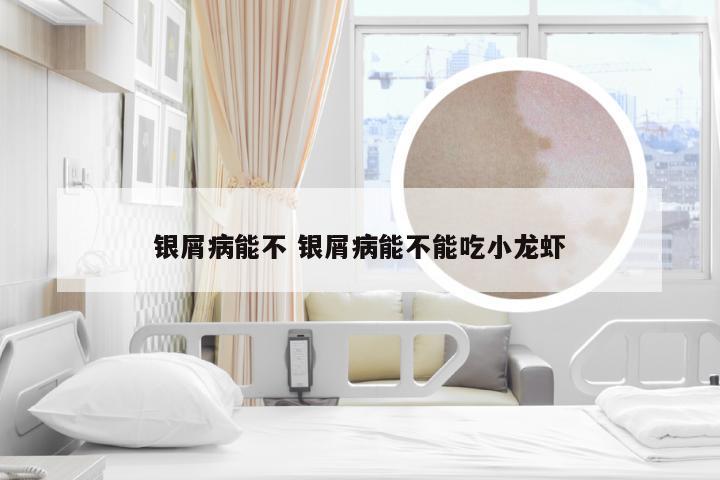 银屑病能不 银屑病能不能吃小龙虾