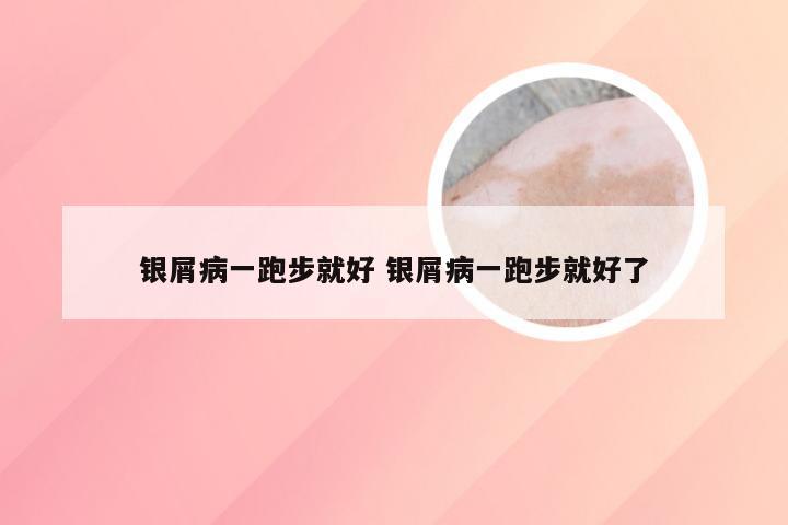 银屑病一跑步就好 银屑病一跑步就好了