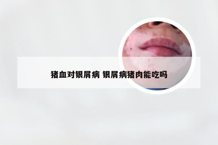 猪血对银屑病 银屑病猪肉能吃吗
