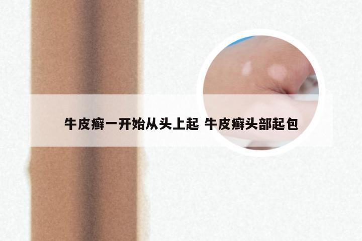 牛皮癣一开始从头上起 牛皮癣头部起包