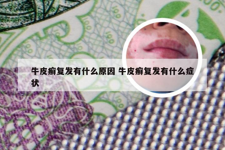 牛皮癣复发有什么原因 牛皮癣复发有什么症状