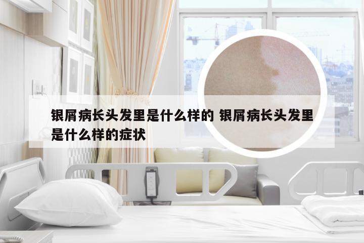 银屑病长头发里是什么样的 银屑病长头发里是什么样的症状