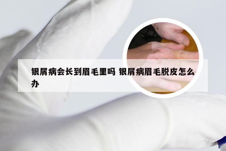银屑病会长到眉毛里吗 银屑病眉毛脱皮怎么办