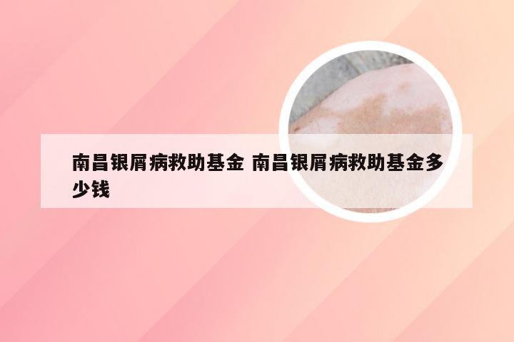 南昌银屑病救助基金 南昌银屑病救助基金多少钱