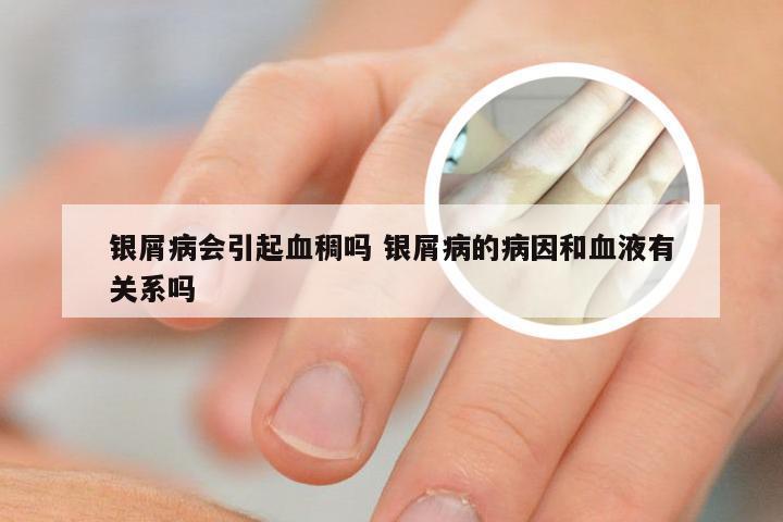 银屑病会引起血稠吗 银屑病的病因和血液有关系吗