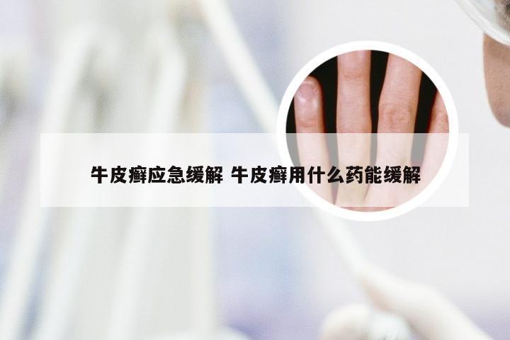 牛皮癣应急缓解 牛皮癣用什么药能缓解
