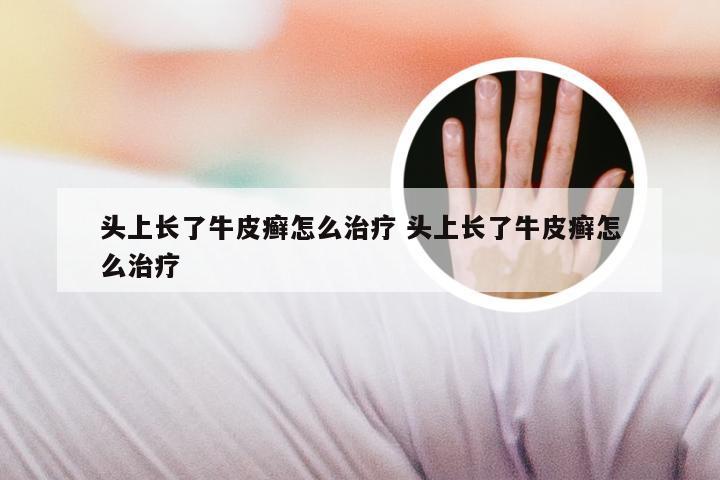 头上长了牛皮癣怎么治疗 头上长了牛皮癣怎么治疗