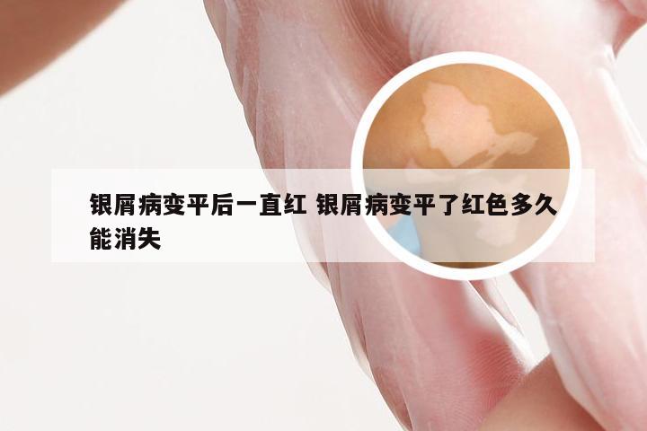 银屑病变平后一直红 银屑病变平了红色多久能消失