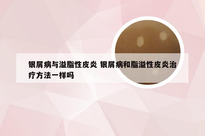银屑病与溢脂性皮炎 银屑病和脂溢性皮炎治疗方法一样吗