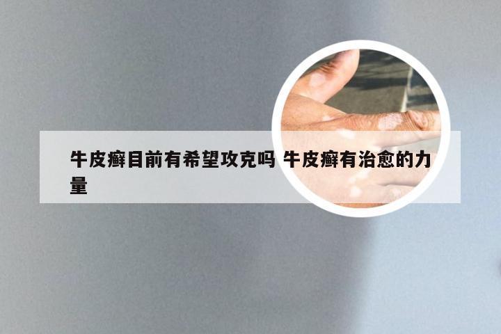 牛皮癣目前有希望攻克吗 牛皮癣有治愈的力量