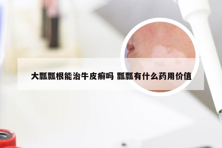 大瓢瓢根能治牛皮癣吗 瓢瓢有什么药用价值