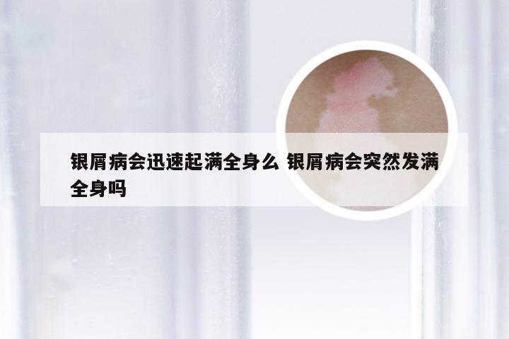 银屑病会迅速起满全身么 银屑病会突然发满全身吗