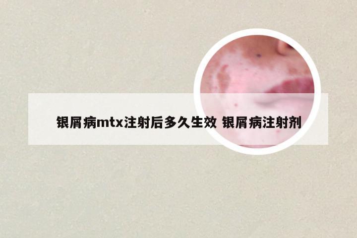 银屑病mtx注射后多久生效 银屑病注射剂