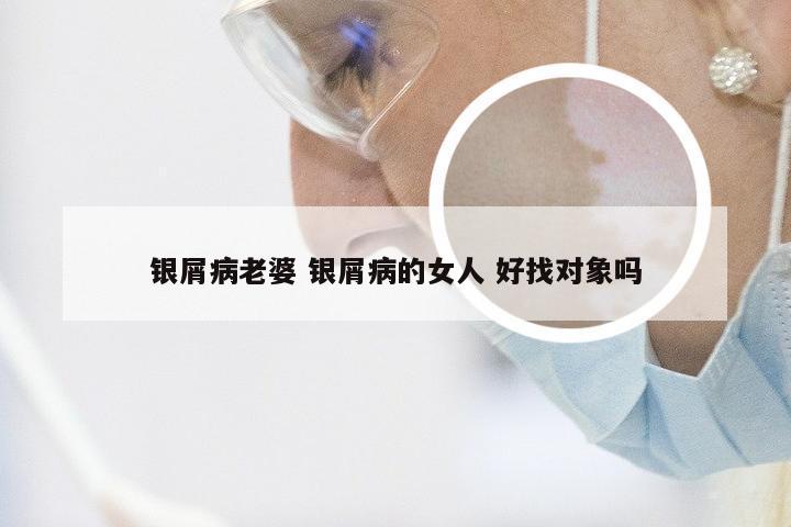 银屑病老婆 银屑病的女人 好找对象吗