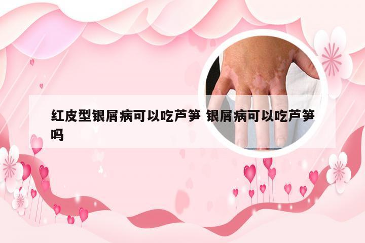 红皮型银屑病可以吃芦笋 银屑病可以吃芦笋吗